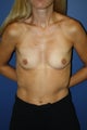 transaxillary endoscopic bilateral breast augmentation