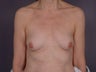 Breast Implants 