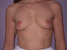 Breast Implants 