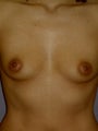 Breast Implant Revision