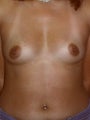 Breast Augmentation
