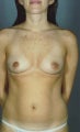 Breast Implants