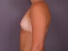 Breast Implants