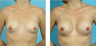 Breast Augmentation