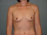 Breast implants