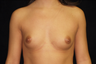 Breast Implants