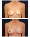 Breast Augmentation