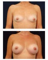 Breast Augmentation
