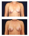 Breast Implants