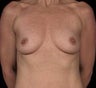 Breast Implants