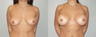 Breast Implants