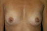 Breast Implants