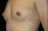 Breast Implants