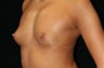 Breast Implants