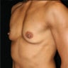 Breast Implants