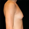 Breast Implants