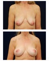 Breast Augmentation with Lift