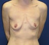 Breast Implants