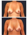 Breast Augmentation