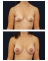 Breast Augmentation
