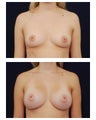 Breast Augmentation