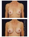 Breast Augmentation