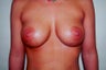 Remove & Replace of Bilateral Breast Implants with Saline Implants