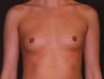 Breast Augmentation