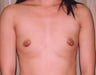 Breast Augmentation
