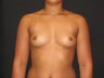 Breast Implants