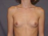 Breast Implants