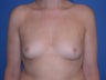 Breast Augmentation