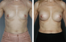 Breast Implants
