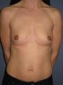 Breast Implants