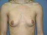 Breast Augmentation