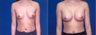 Breast Augmentation with Implants