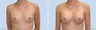 Breast Augmentation