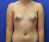 Breast Augmentation