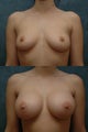 Breast Implants