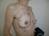 Augmentation Mammaplasty