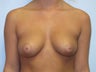 Breast Augmentation 