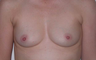 Breast Augmentation