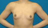 Breast Augmentation