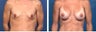 Breast Implants