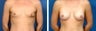 Breast Implants