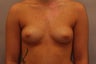 Breast Implants