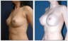 Breast Implants
