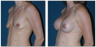 Breast Implants