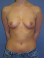 Breast Implants