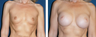 Breast Implants